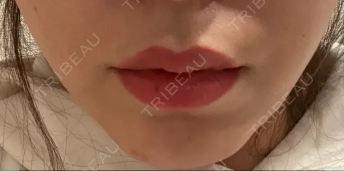 ボトックス（人中） veary clinic DAY 15 メイン用