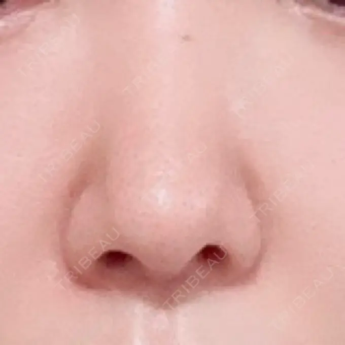 鼻尖形成（切開） / 鼻中隔延長（切開） / 鼻孔縁下降 / その他（目元） みずほクリニック DAY 17 メイン用