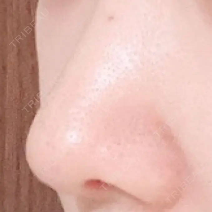 鼻尖形成（切開） / 鼻中隔延長（切開） / 鼻孔縁下降 / その他（目元） みずほクリニック DAY 17 メイン用