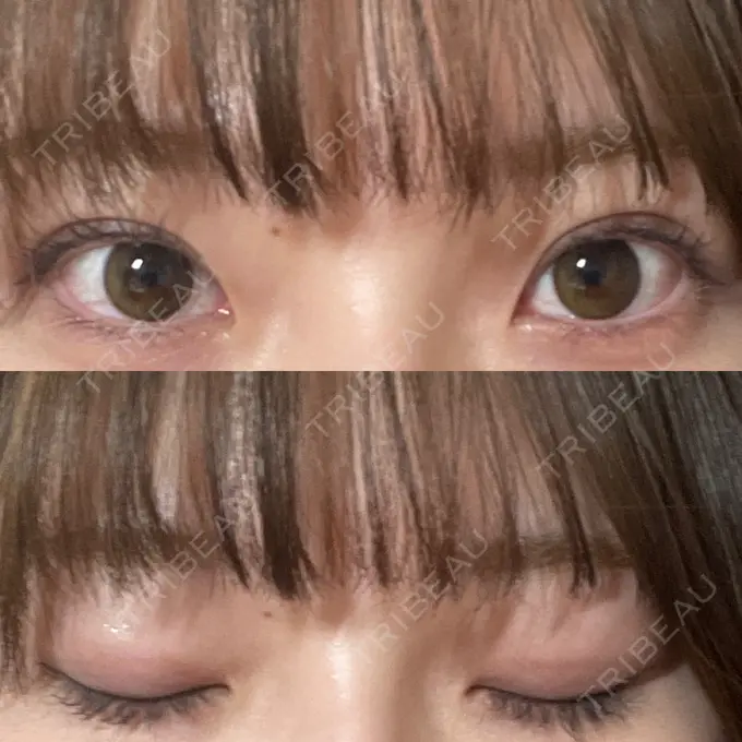 二重埋没 湘南美容クリニック 京都院 AFTER メイン用