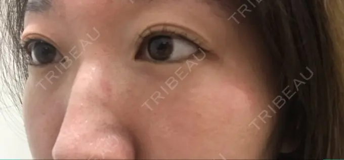 美肌レーザー / シミ取りレーザー / ルビーレーザー 銀座お肌の診療所 DAY 14 メイン用