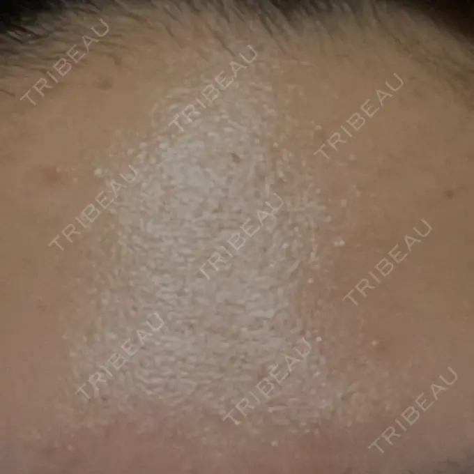 ピコレーザートーニング（美白・肝斑） ルラ美容クリニック 高田馬場院 AFTER メイン用