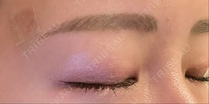 ほくろ・いぼ切除（肌） ルラ美容クリニック 渋谷本院 DAY 0 メイン用