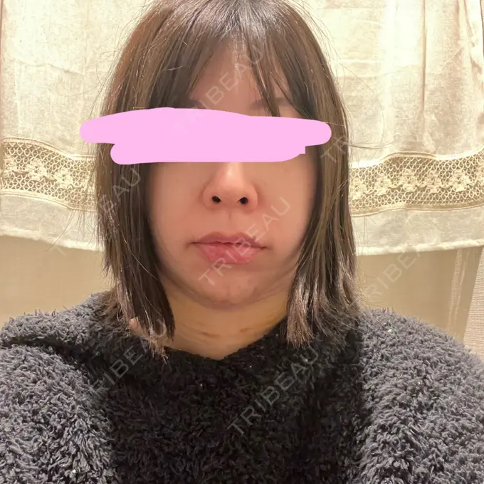 脂肪吸引（顔） みずほクリニック DAY 4 メイン用