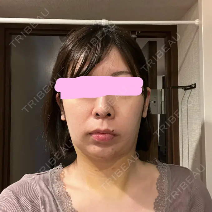 脂肪吸引（顔） みずほクリニック DAY 5 メイン用