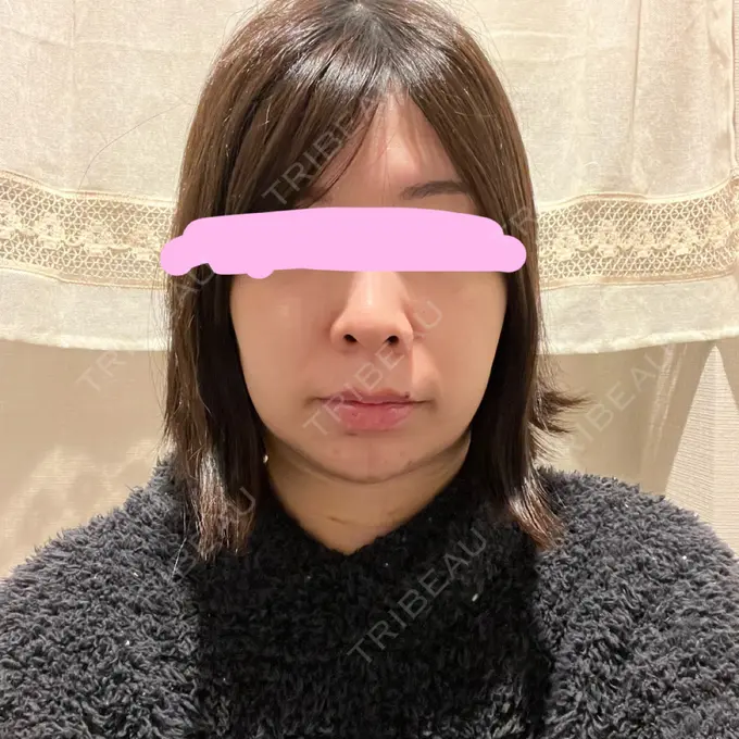 脂肪吸引（顔） みずほクリニック DAY 6 メイン用