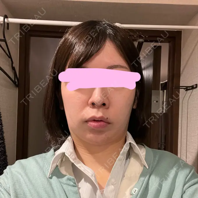 脂肪吸引（顔） みずほクリニック DAY 8 メイン用