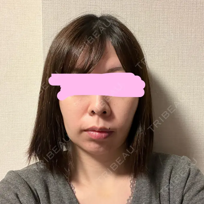 脂肪吸引（顔） みずほクリニック DAY 10 メイン用