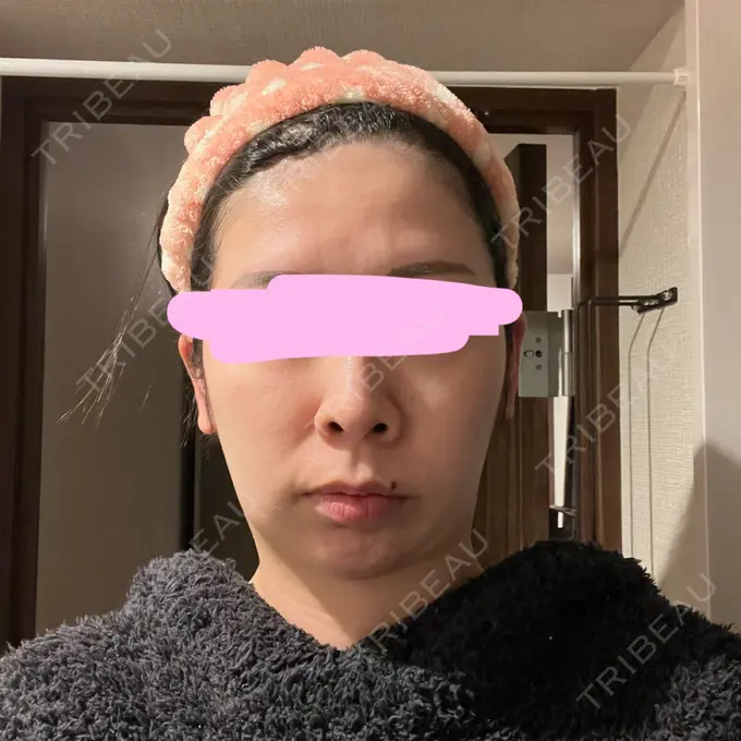 脂肪吸引（顔） みずほクリニック DAY 14 メイン用