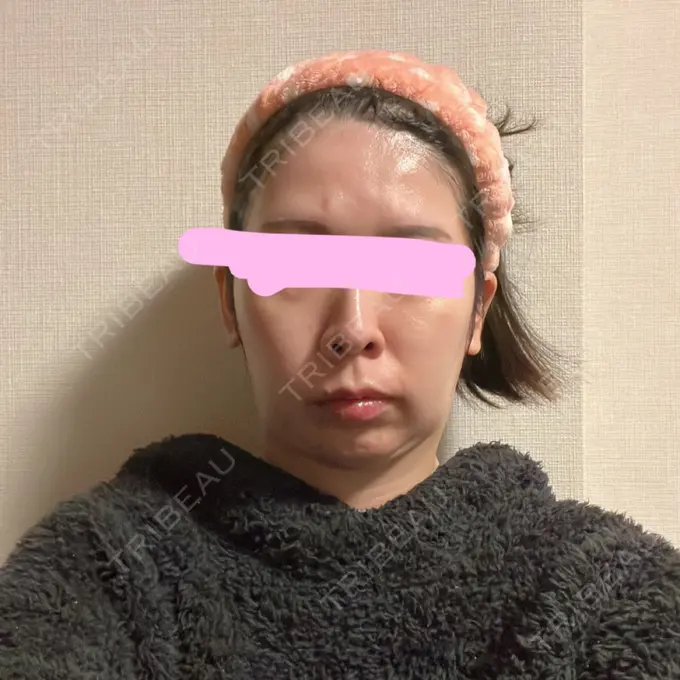脂肪吸引（顔） みずほクリニック AFTER メイン用