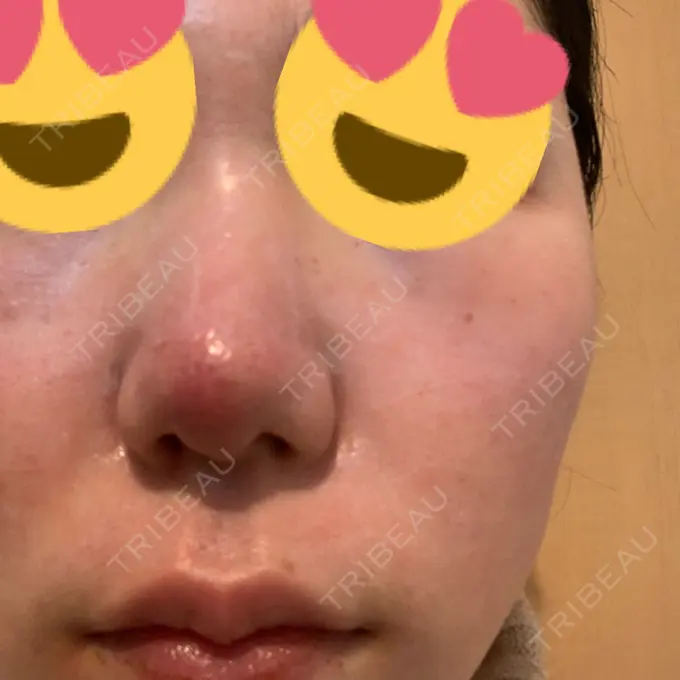 その他（肌） / ポテンツァ LOUIS CLINIC 二子玉川院【ルイクリニック】 DAY 0 メイン用