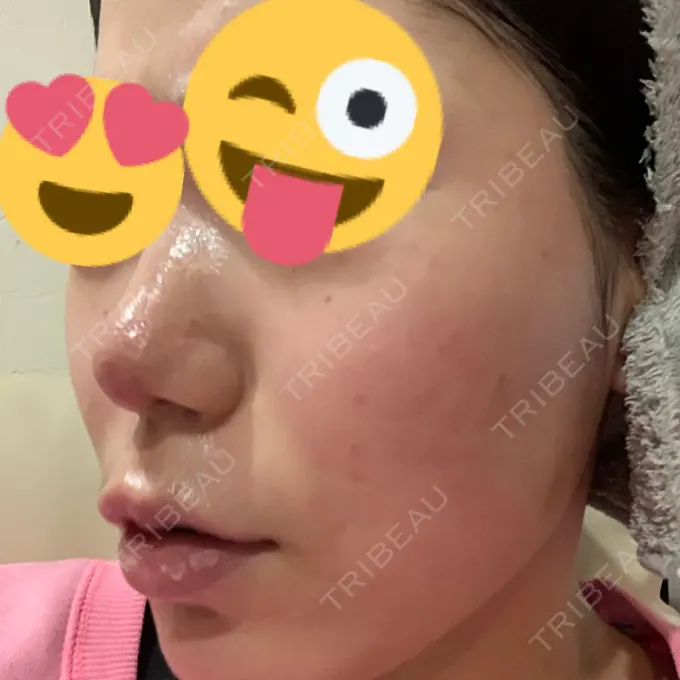 その他（肌） / ポテンツァ LOUIS CLINIC 二子玉川院【ルイクリニック】 DAY 4 メイン用