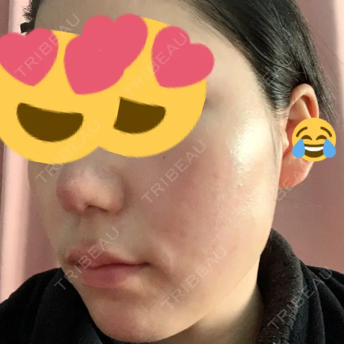 その他（肌） / ポテンツァ LOUIS CLINIC 二子玉川院【ルイクリニック】 AFTER メイン用