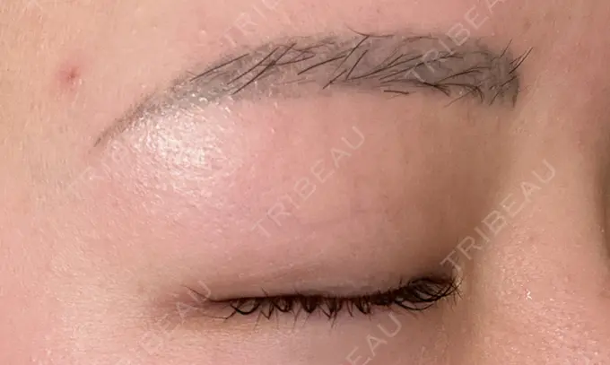 ほくろ・いぼ切除（肌） ルラ美容クリニック 渋谷本院 DAY 1 メイン用