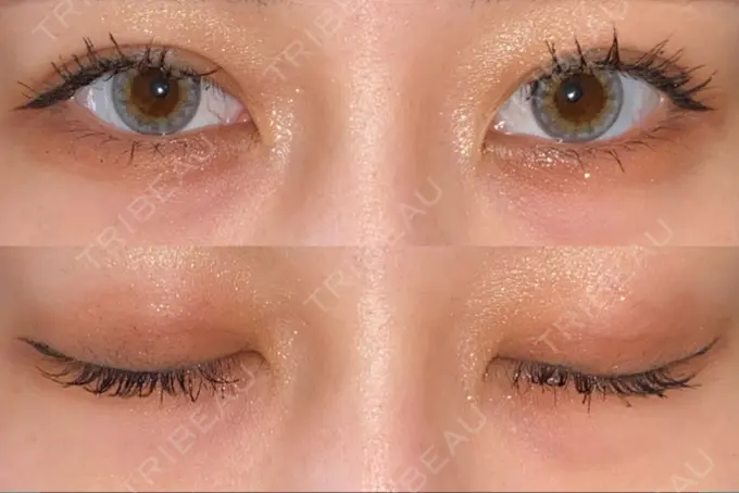 二重埋没 アリエル美容クリニック 郡山院 AFTER メイン用