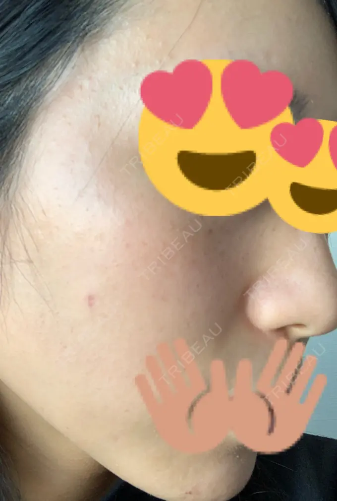 ほくろ・いぼ切除（肌） / 高濃度ビタミンC点滴 TCB東京中央美容外科 広島院 DAY 31 メイン用