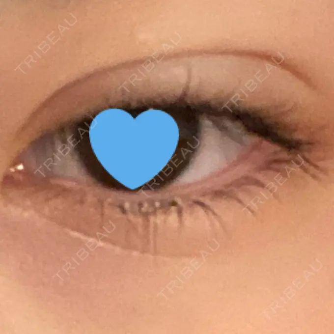 二重埋没 ネビュラクリニック 広島院 DAY 0 メイン用