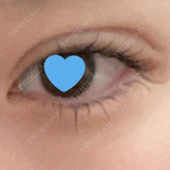 二重埋没 ネビュラクリニック 広島院 DAY 2 メイン用