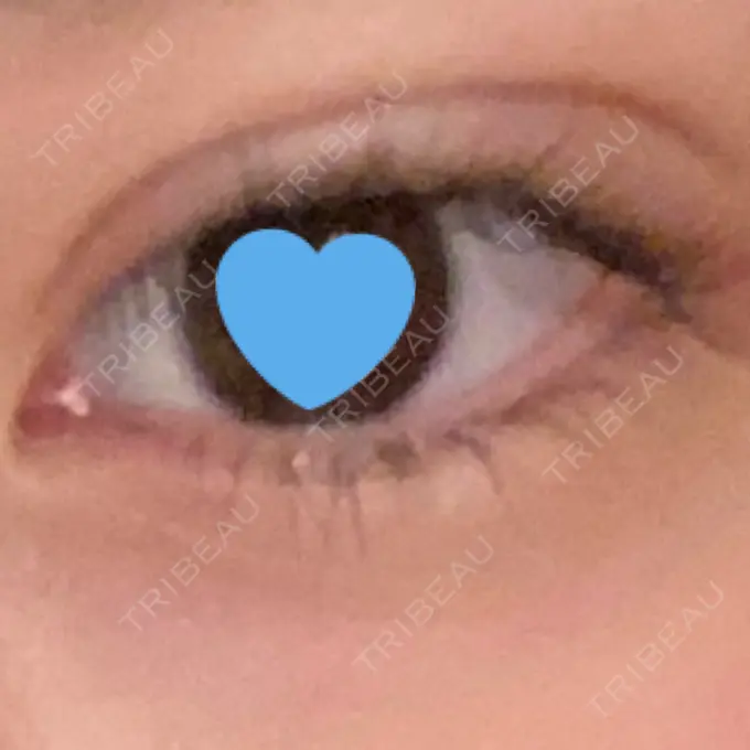 二重埋没 ネビュラクリニック 広島院 AFTER メイン用