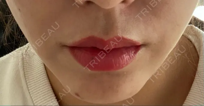 ボトックス（人中） veary clinic DAY 20 メイン用