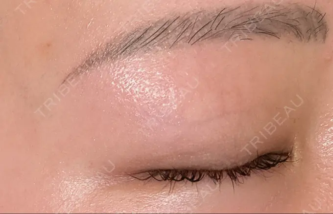 ほくろ・いぼ切除（肌） ルラ美容クリニック 渋谷本院 DAY 4 メイン用