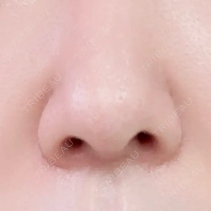 鼻尖形成（切開） / 鼻中隔延長（切開） / 鼻孔縁下降 / その他（目元） みずほクリニック DAY 24 メイン用