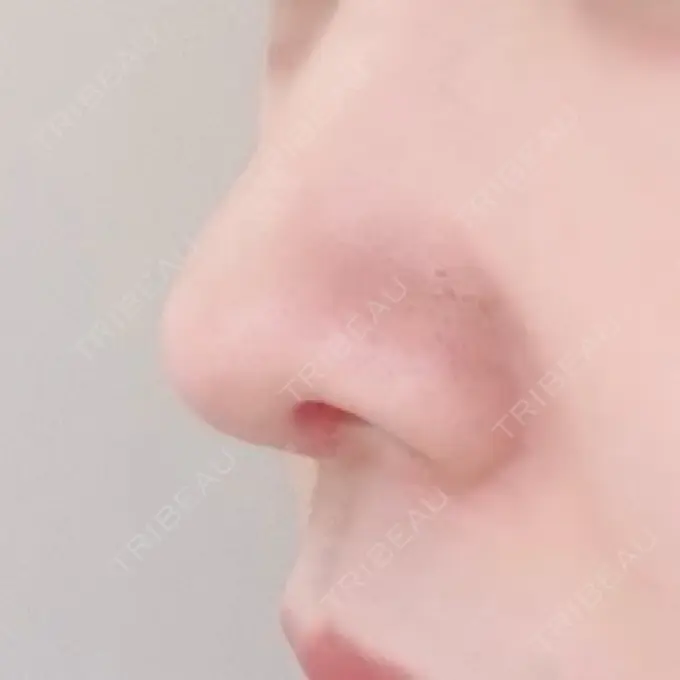 鼻尖形成（切開） / 鼻中隔延長（切開） / 鼻孔縁下降 / その他（目元） みずほクリニック DAY 24 メイン用