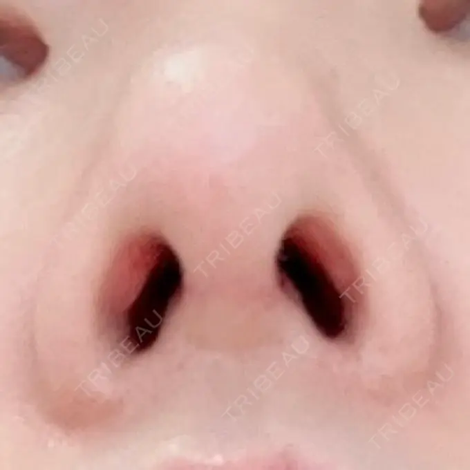 鼻尖形成（切開） / 鼻中隔延長（切開） / 鼻孔縁下降 / その他（目元） みずほクリニック DAY 24 メイン用