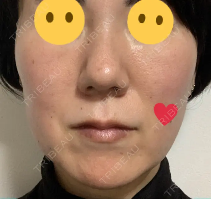 糸リフト 吉井クリニック DAY 0 メイン用