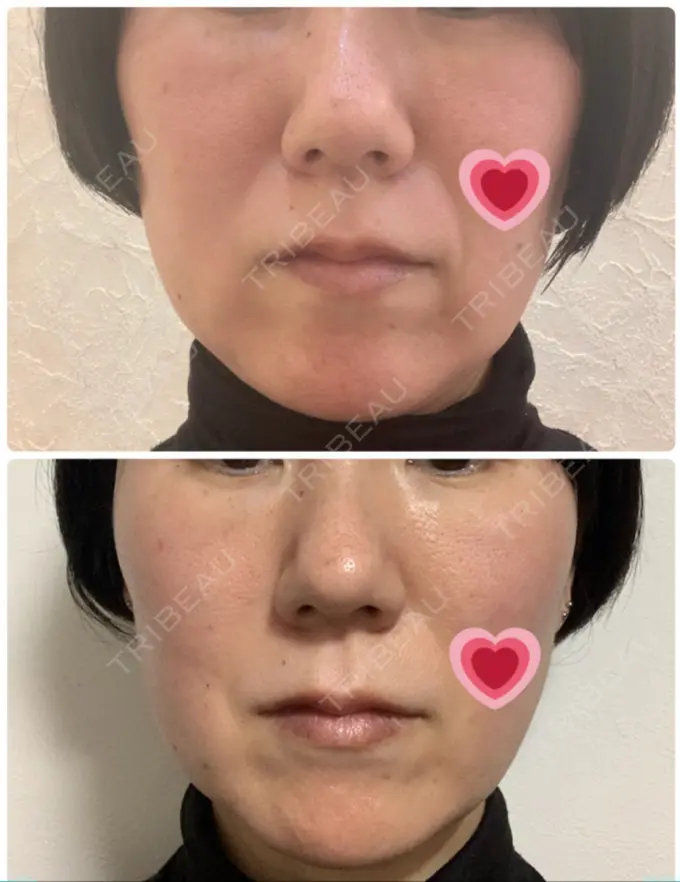 糸リフト 吉井クリニック DAY 0 メイン用