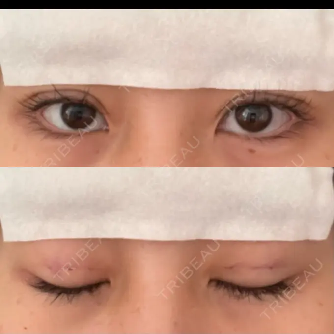 二重埋没 十仁美容整形 DAY 1 メイン用