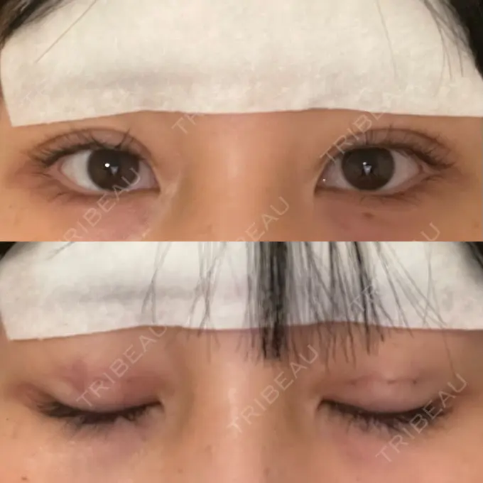 二重埋没 十仁美容整形 DAY 2 メイン用