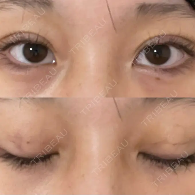 二重埋没 十仁美容整形 DAY 3 メイン用