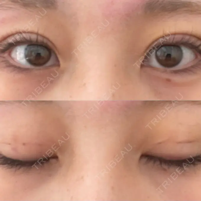 二重埋没 十仁美容整形 DAY 4 メイン用