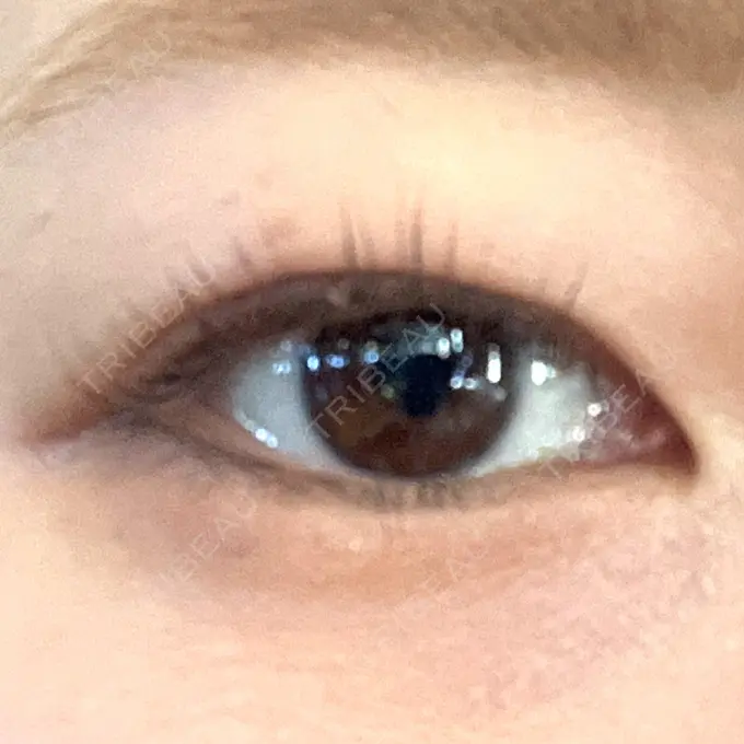 二重埋没 ネビュラクリニック 広島院 DAY 32 メイン用