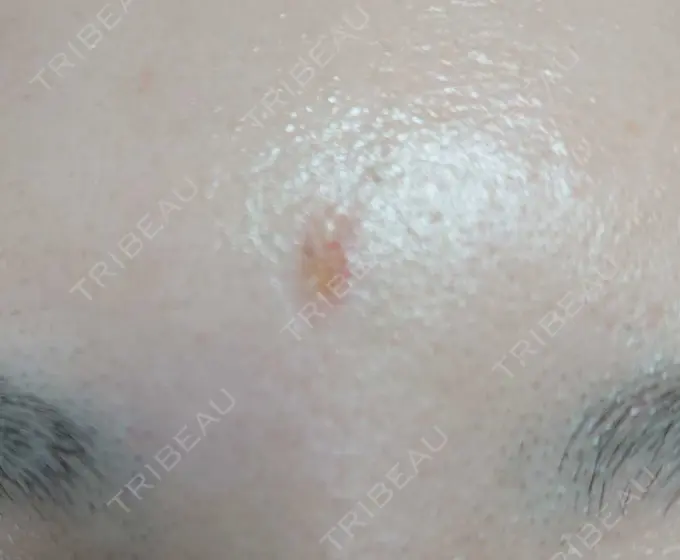 傷跡修正 / 傷跡修正 TETSU形成・美容クリニック DAY 2 メイン用