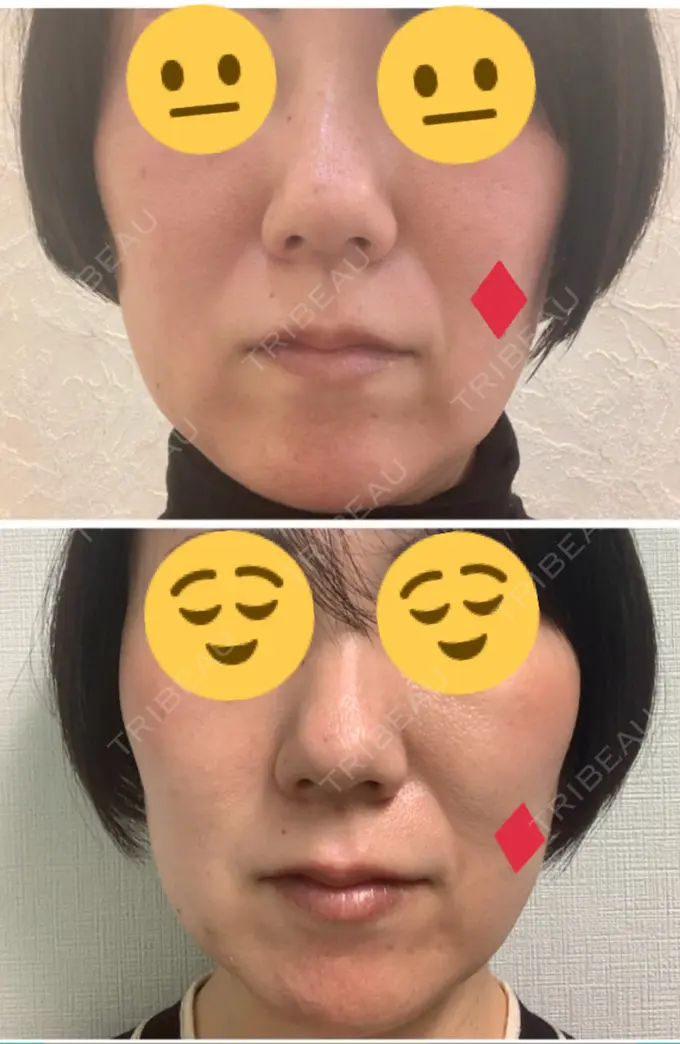 糸リフト 吉井クリニック DAY 3 メイン用