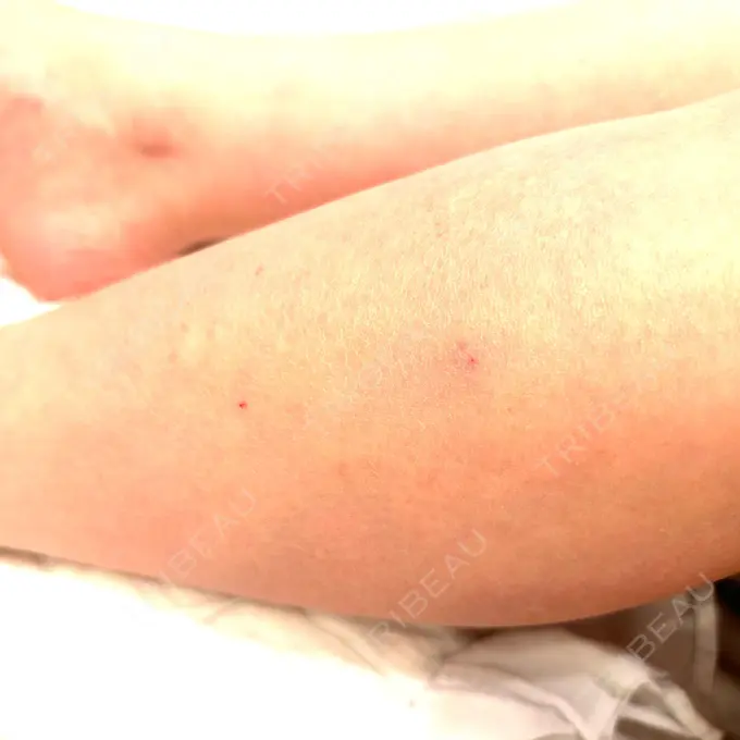 ボトックス（ふくらはぎ） LEAGRANT CLINIC 中目黒 DAY 0 メイン用