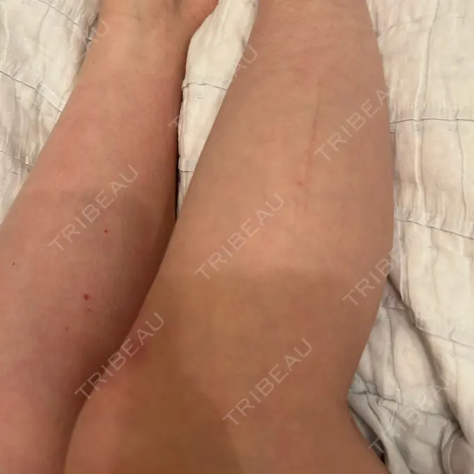 ボトックス（ふくらはぎ） LEAGRANT CLINIC 中目黒 DAY 0 メイン用