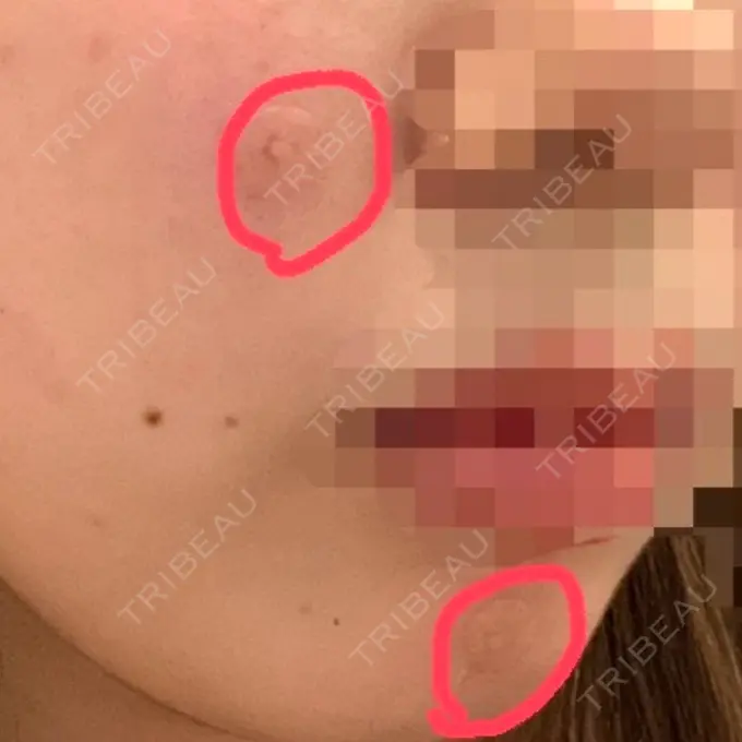 ほくろ・いぼ切除（肌） LIKI CLINIC KOBE DAY 0 メイン用