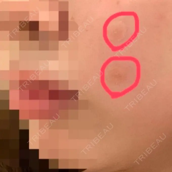 ほくろ・いぼ切除（肌） LIKI CLINIC KOBE DAY 0 メイン用