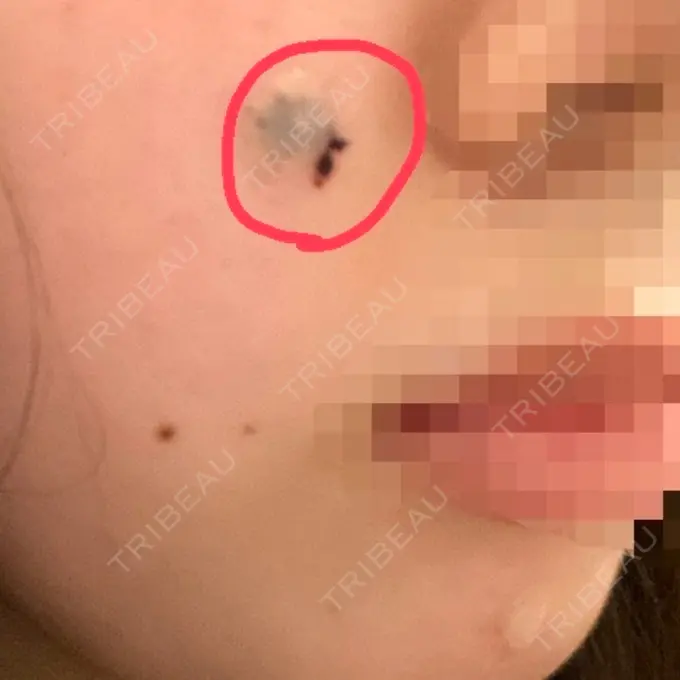 ほくろ・いぼ切除（肌） LIKI CLINIC KOBE DAY 0 メイン用