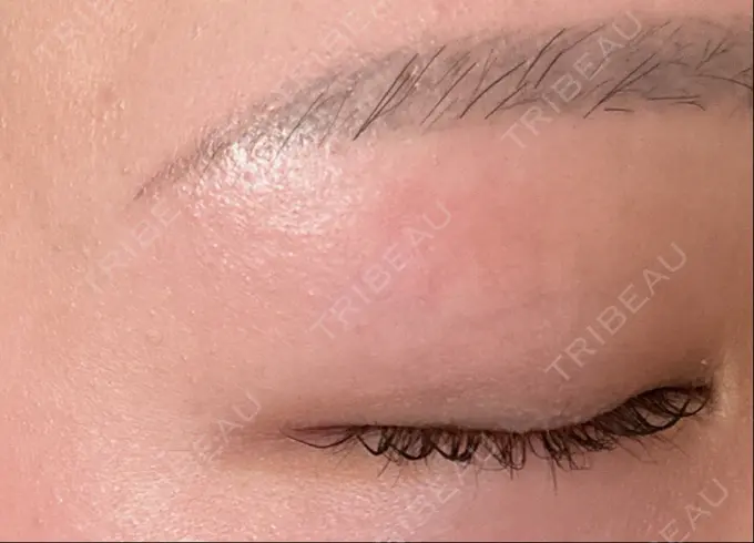 ほくろ・いぼ切除（肌） ルラ美容クリニック 渋谷本院 AFTER メイン用