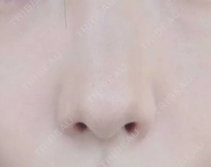 鼻孔縁挙上 シエルクリニック AFTER メイン用