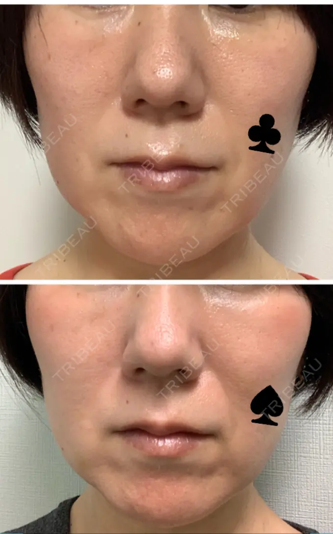 糸リフト 吉井クリニック DAY 8 メイン用