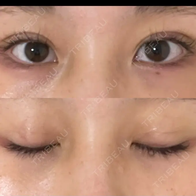 二重埋没 十仁美容整形 DAY 5 メイン用