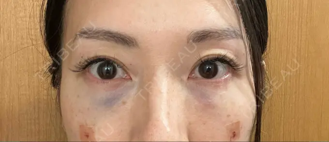 クマ治療 セオリークリニック DAY 0 メイン用