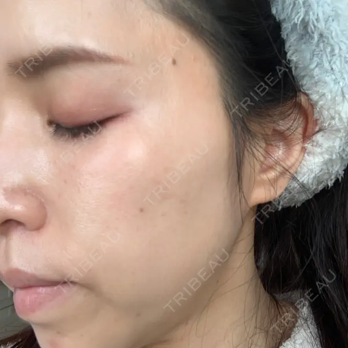 ニードルRF（ポテンツァなど） オラクル美容皮膚科 名古屋院 DAY 0 メイン用