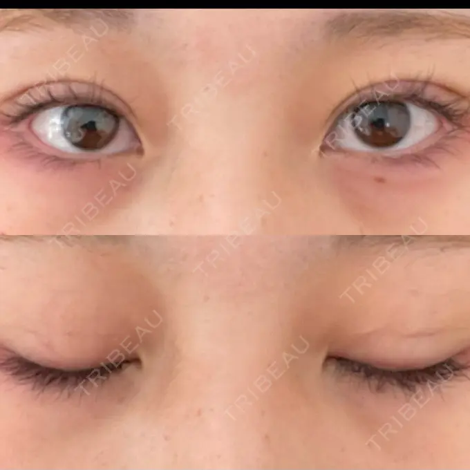 二重埋没 十仁美容整形 DAY 6 メイン用