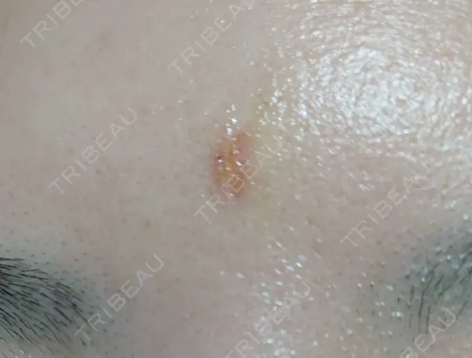 傷跡修正 / 傷跡修正 TETSU形成・美容クリニック DAY 4 メイン用